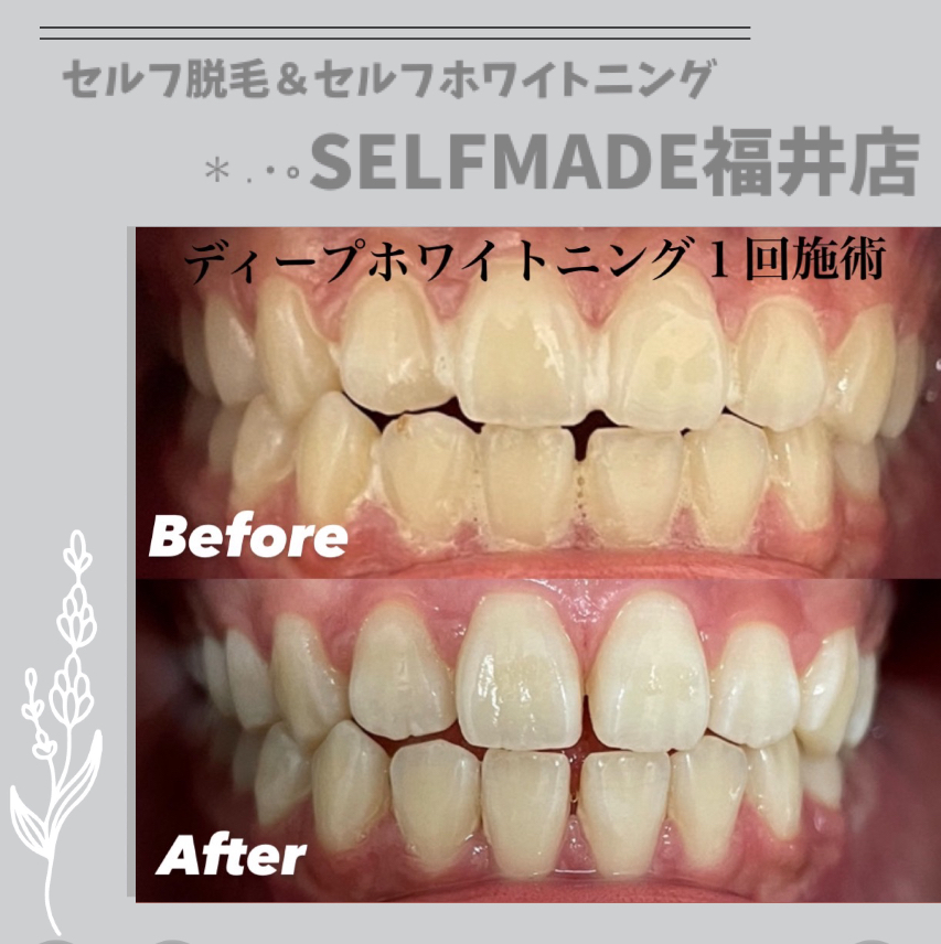 福井店blog】新医療ホワイトニングのディープホワイトニングお試し