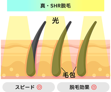 SHR脱毛